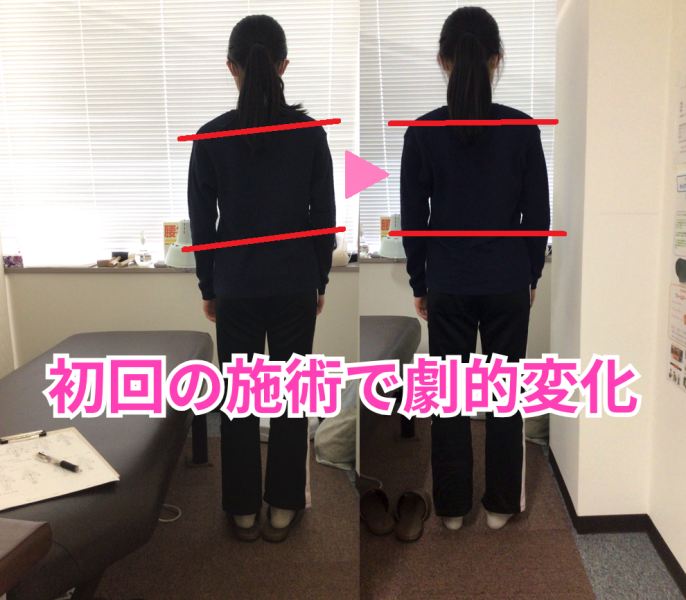 骨盤矯正BA